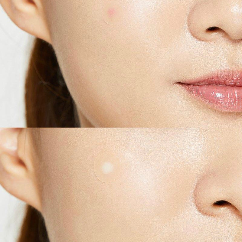 Acne Pimple Master Patch by COSRX, view 2